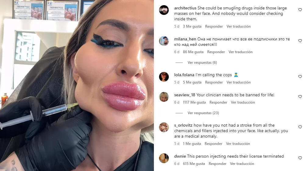 La influencer ucraniana con "las mejillas más grandes del mundo" La influencer ucraniana con "las mejillas más grandes del mundo"