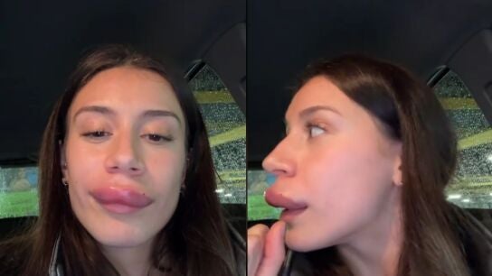 Las impactantes secuelas tras ponerse &aacute;cido hialur&oacute;nico en los labios