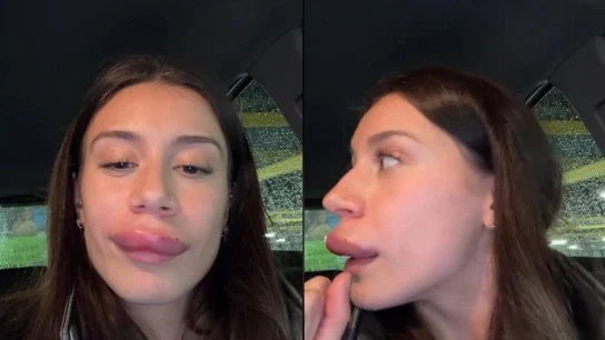 Las impactantes secuelas tras ponerse ácido hialurónico en los labios Las impactantes secuelas tras ponerse ácido hialurónico en los labios