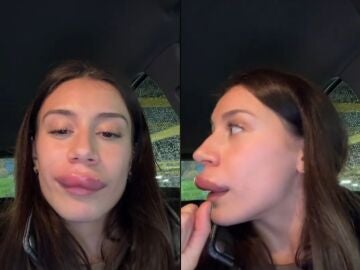 Las impactantes secuelas tras ponerse &aacute;cido hialur&oacute;nico en los labios