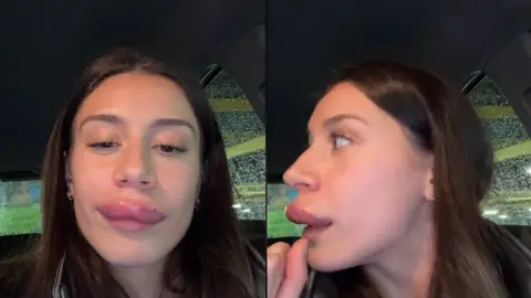 Las impactantes secuelas tras ponerse ácido hialurónico en los labios Las impactantes secuelas tras ponerse ácido hialurónico en los labios