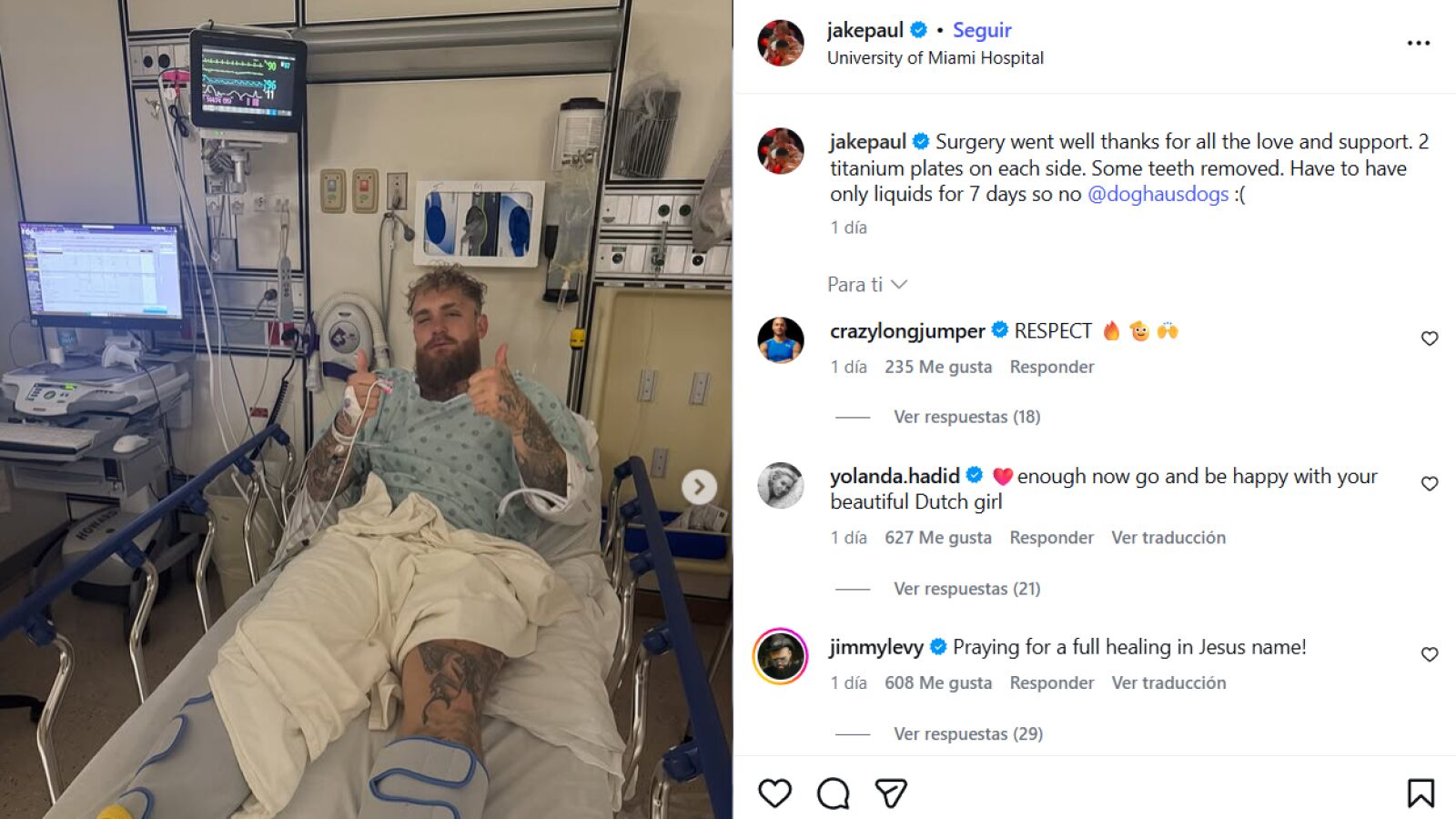 Jake Paul y su operación de mandíbula: rotura doble tras el combate contra Anthony Joshua